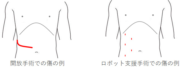 開放手術とロボット支援手術での傷の例の図