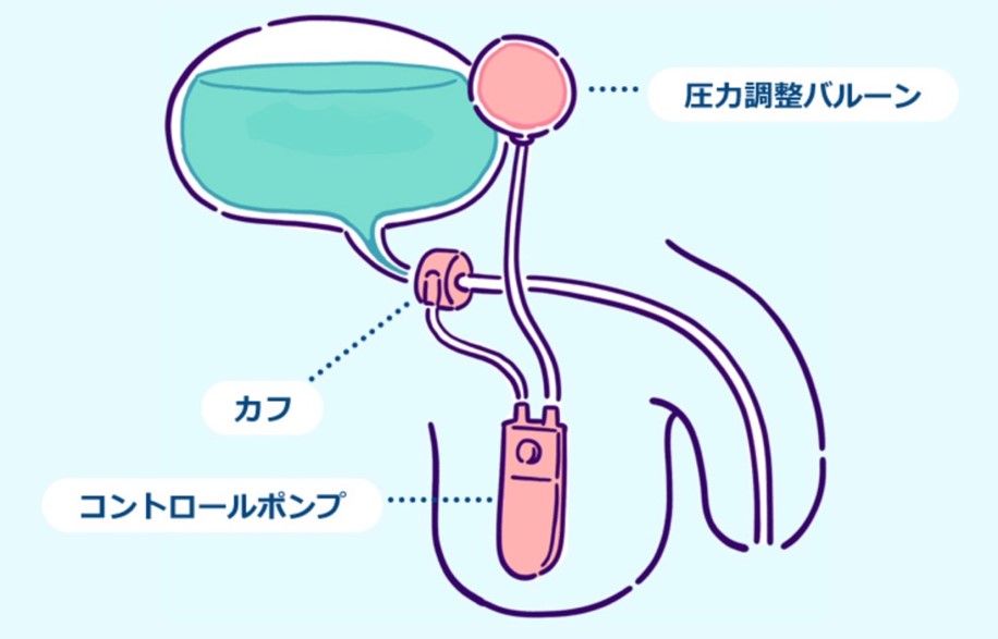 人工尿道括約筋の説明図