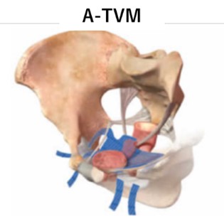 TVM手術の図