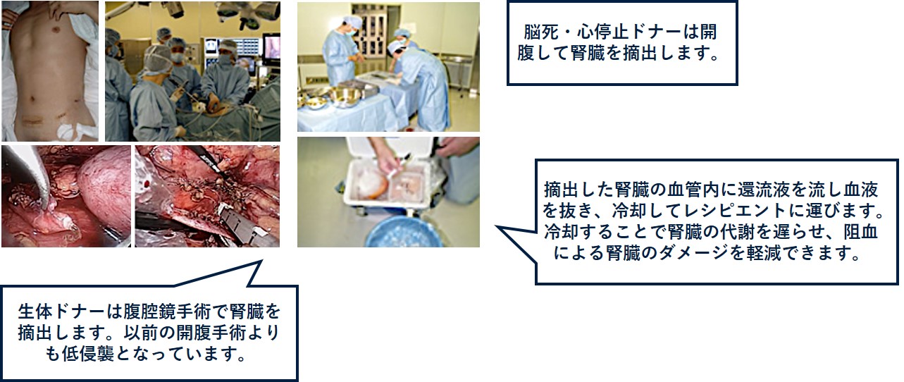 腎移植手術の説明図