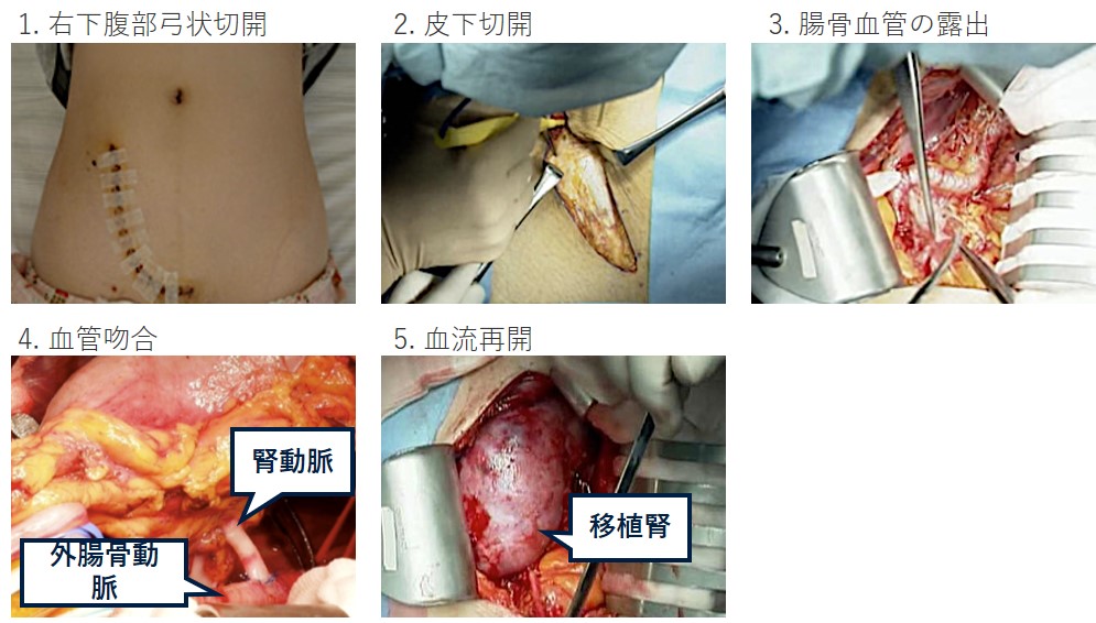 腎移植手術の各工程の説明図